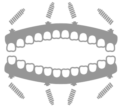 両あごインプラント