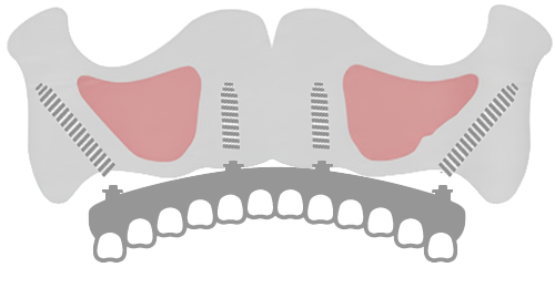 ザイゴマインプラント