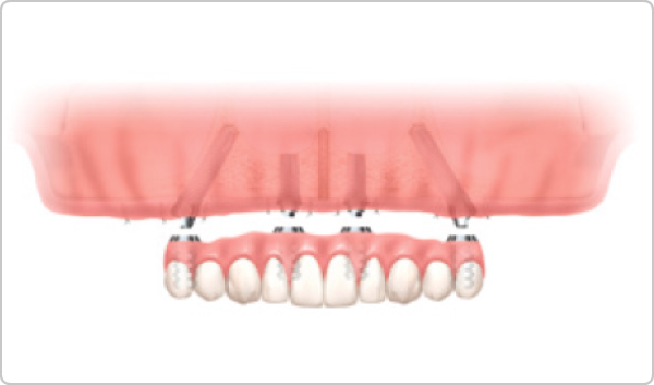 ALL-on-4の特徴